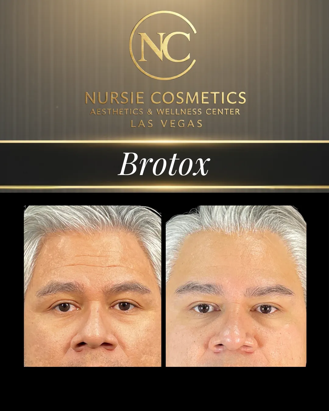 Before and after neurotoxin treatment for men