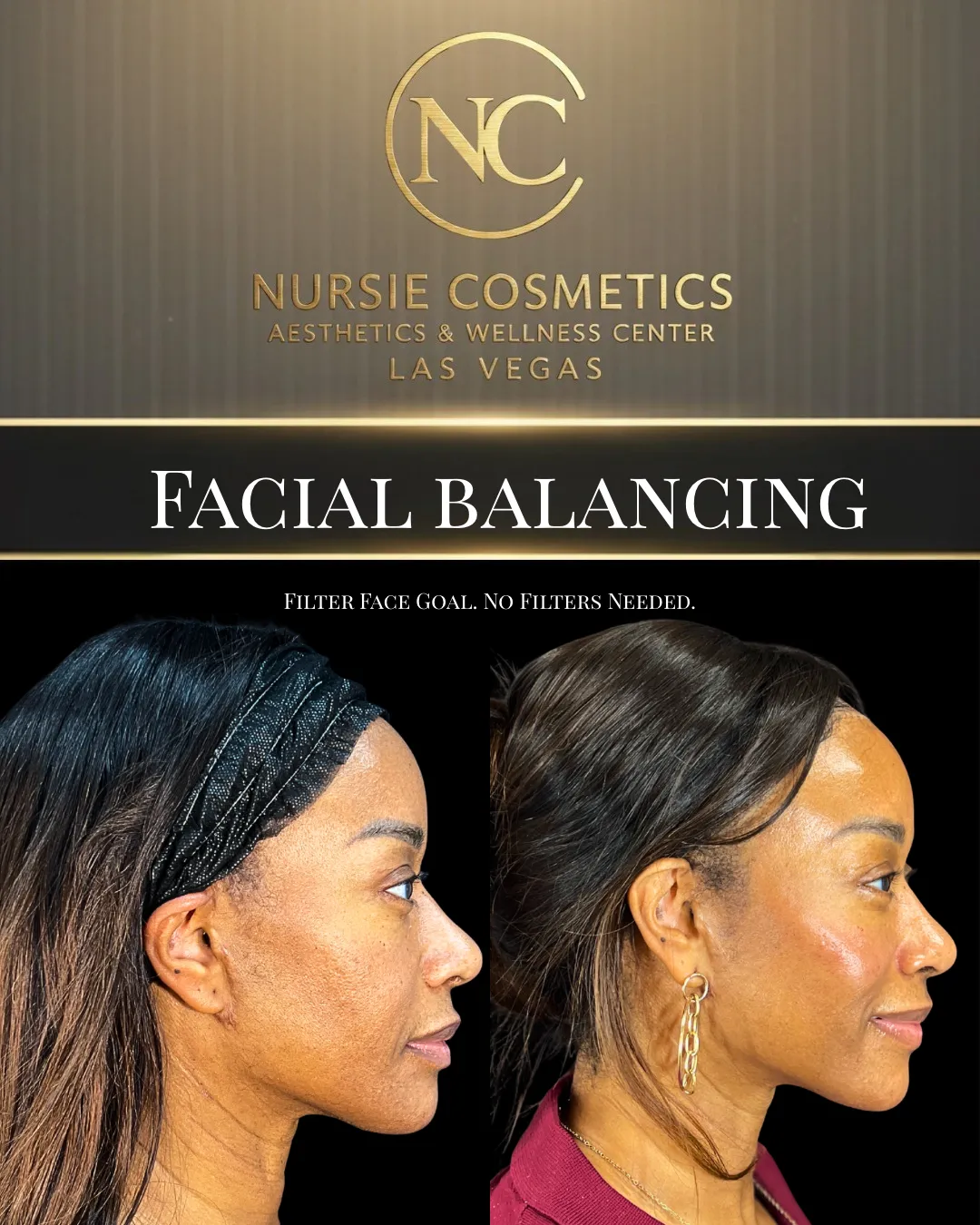 Before and after facial balancing, profile view