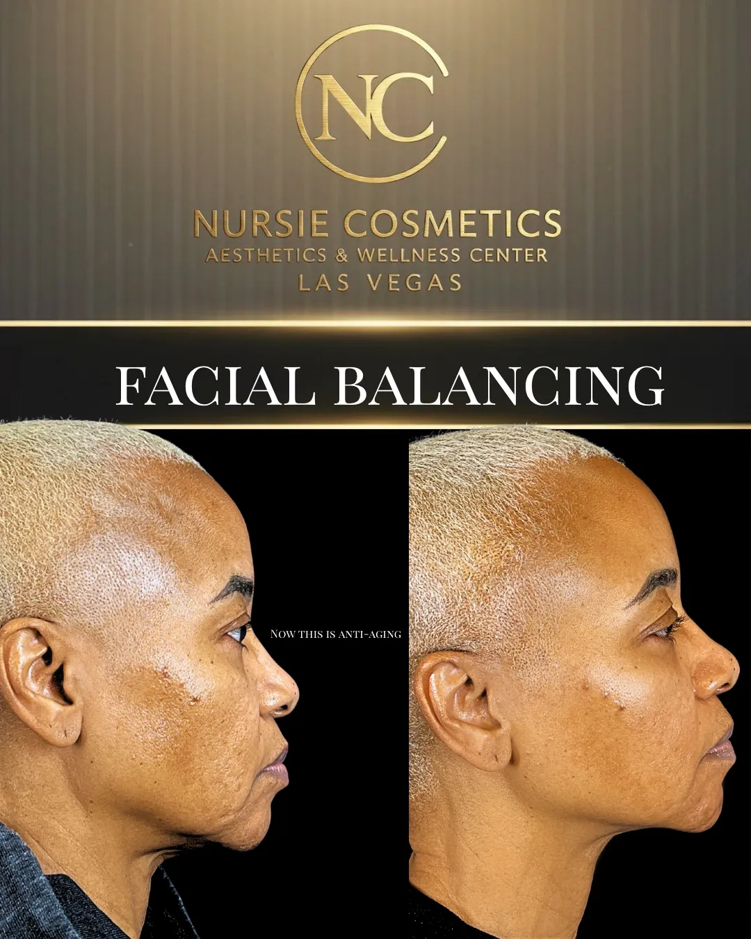 Before and after facial balancing