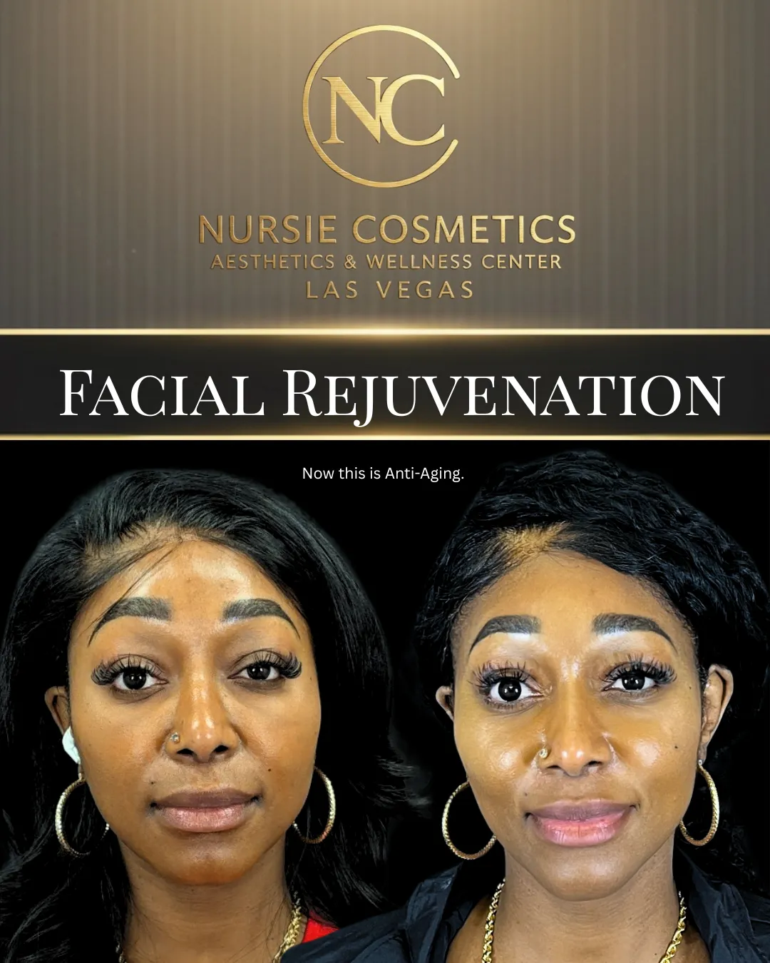 Before and after facial rejuvenation