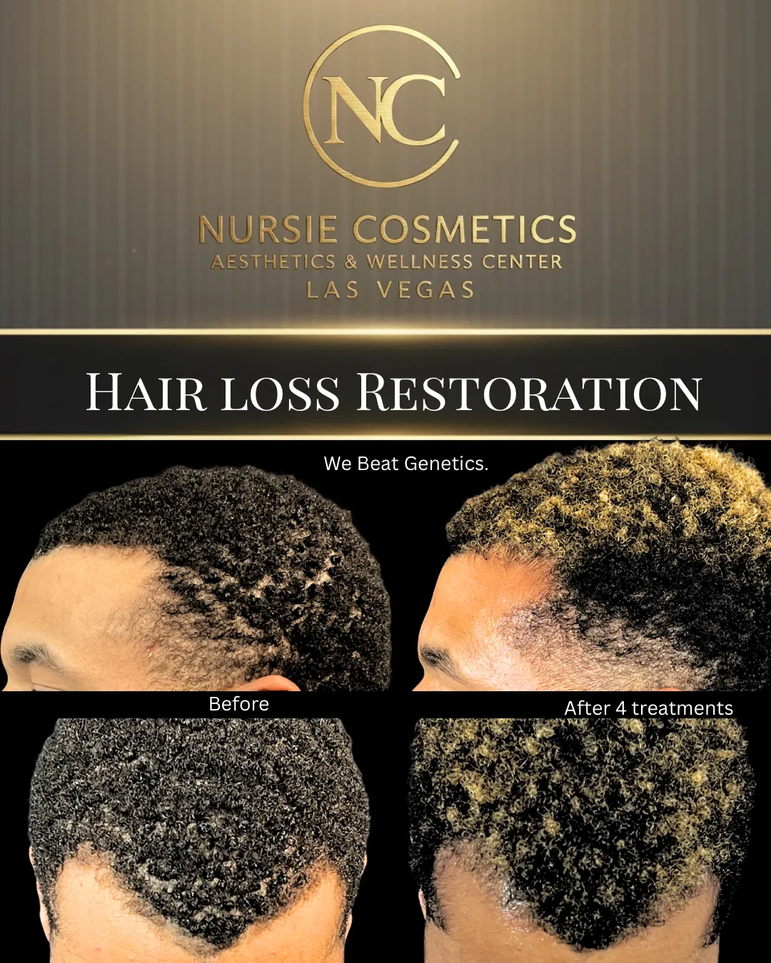 Before and after hair loss restoration