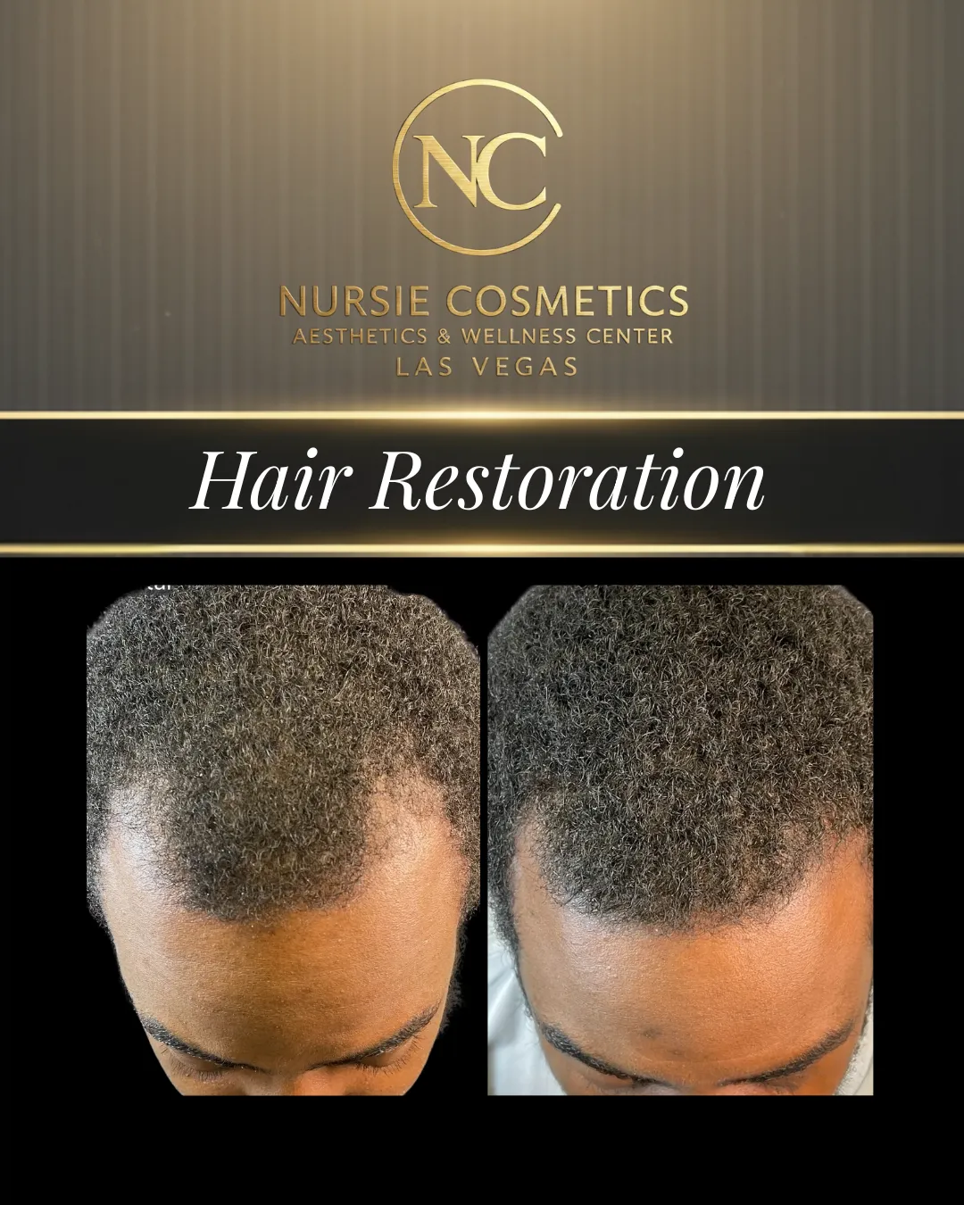 Before and after hair restoration