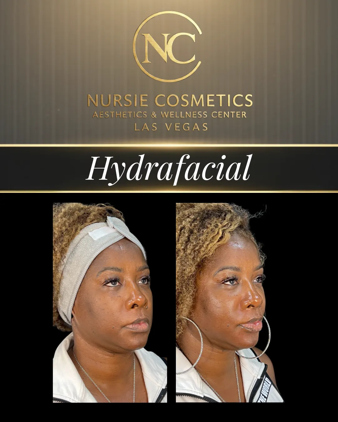 Before and after hydrafacial at Nursie Cosmetics
