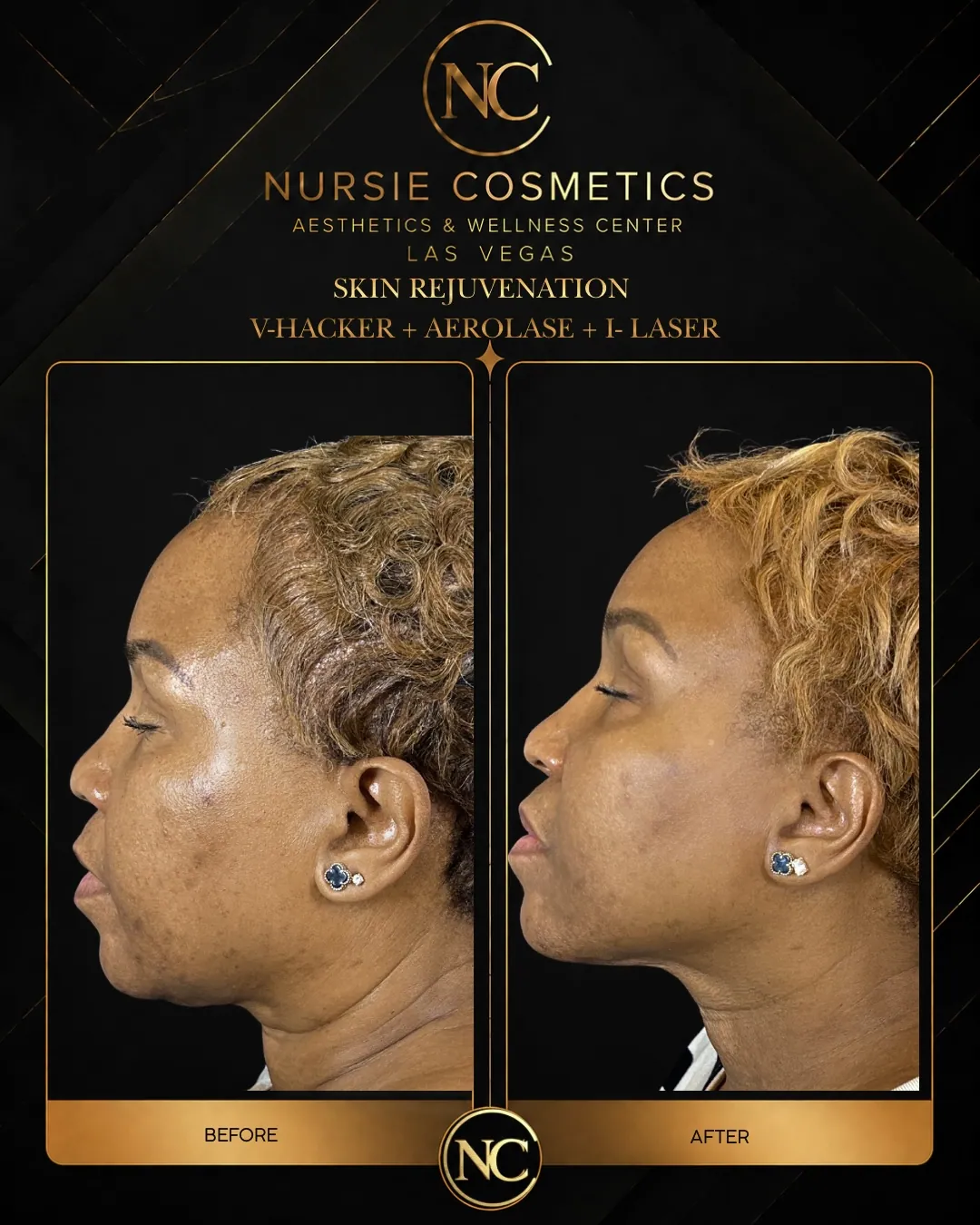 Before and after I-Laser and Aerolase skin renewal