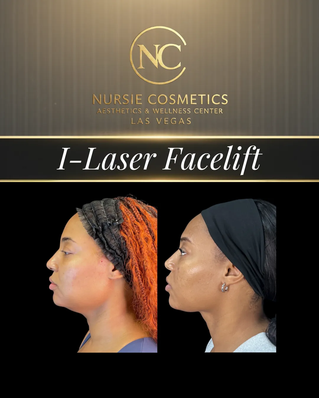 Before and after an I-Laser facelift at Nursie Cosmetics