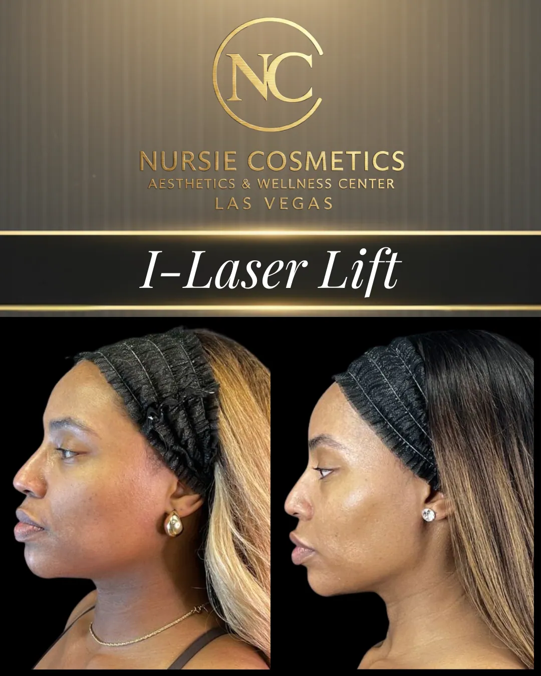 Before and after an I-Laser Lift at Nursie Cosmetics