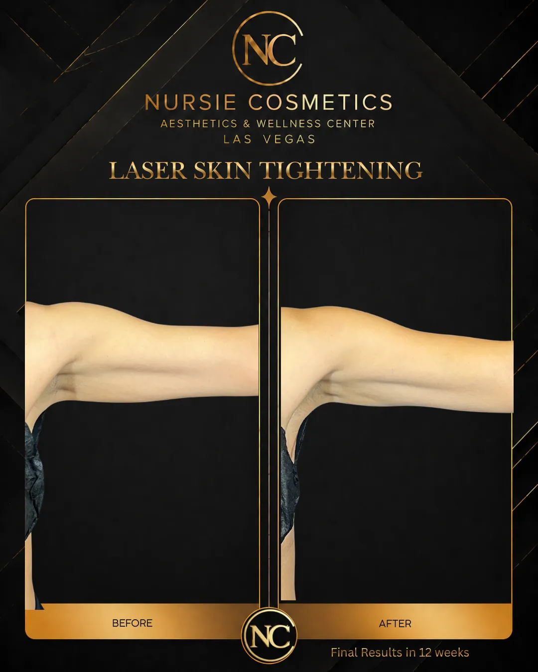 Before and after laser skin tightening on the arms