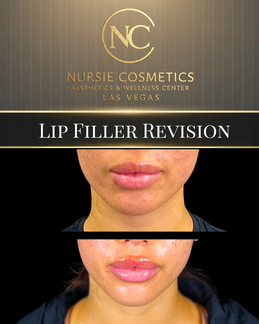 Before and after lip filler revision