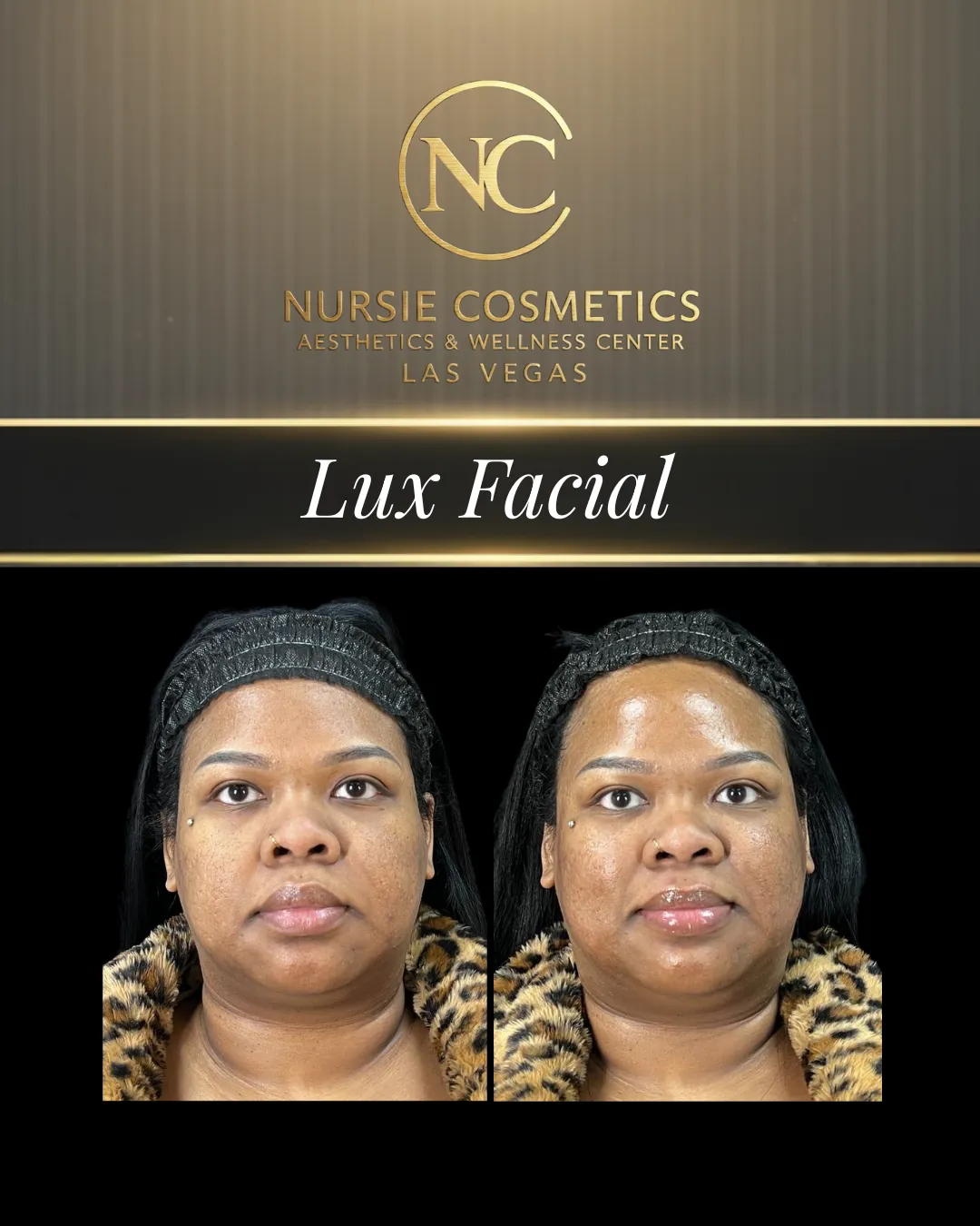 Before and after lux facial