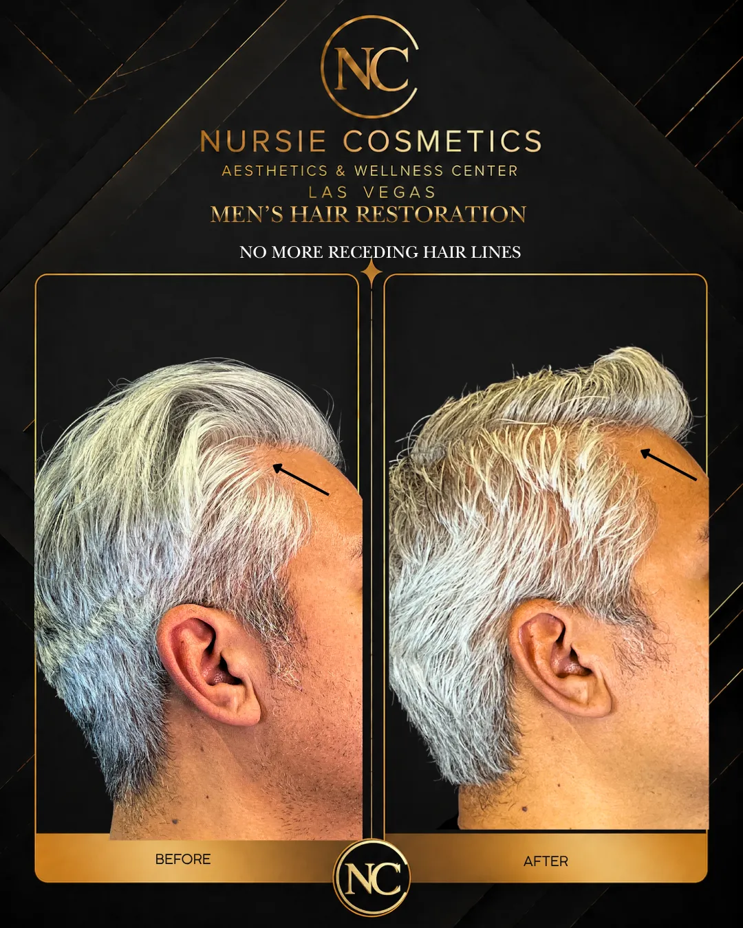 Before and after men's hair restoration