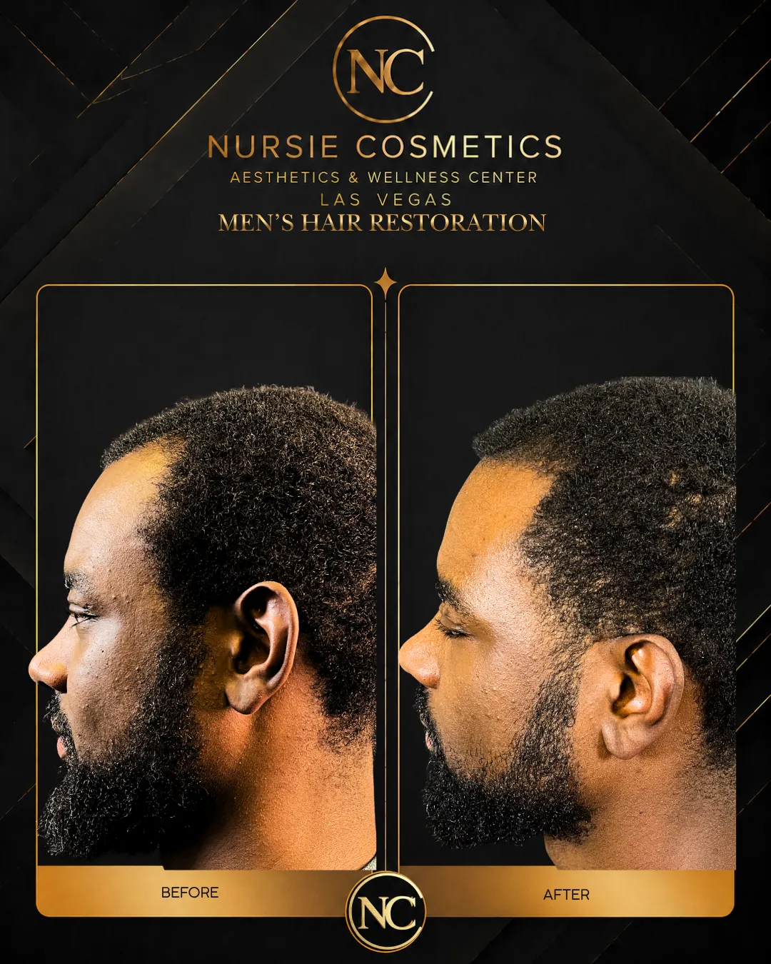 Before and after men's hair restoration, no more receding hair line