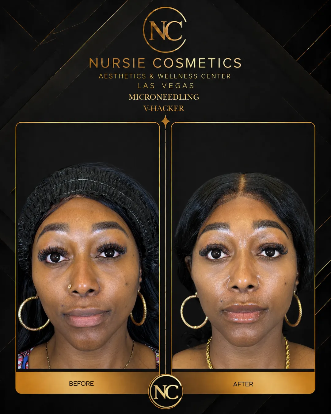 Before and after microneedling skin renewal
