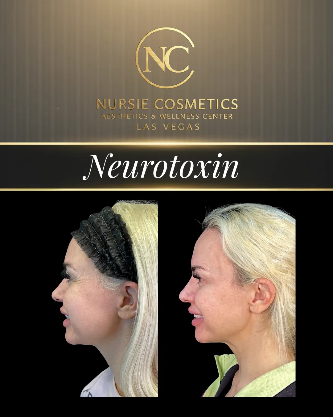 Before and after neurotoxin treatment at Nursie Cosmetics