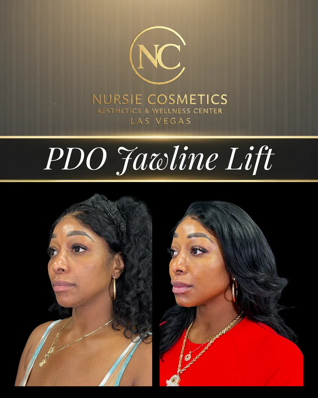 Before and after PDO jawline lift at Nursie Cosmetics