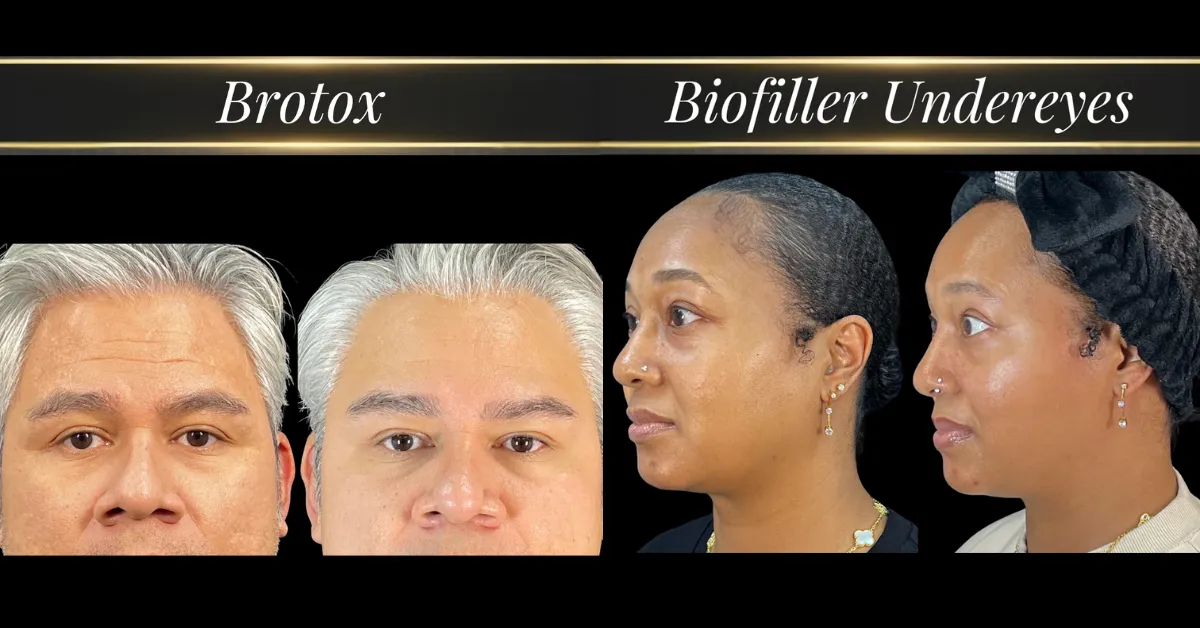 Before and after brotox and biofiller under-eyes