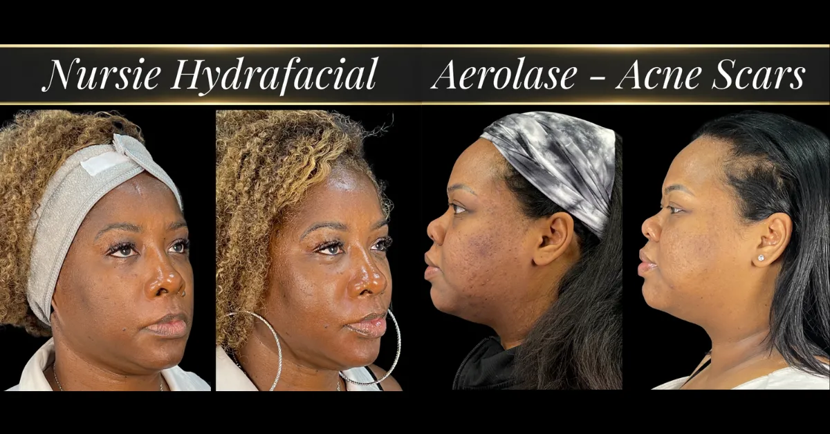 Before and after Nursie hydrafacial and Aerolase for acne scars