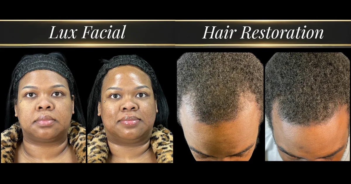 Before and after lux facial and hair restoration