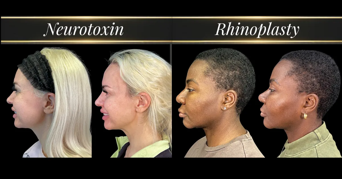 Before and after neurotoxin and non-surgical rhinoplasty
