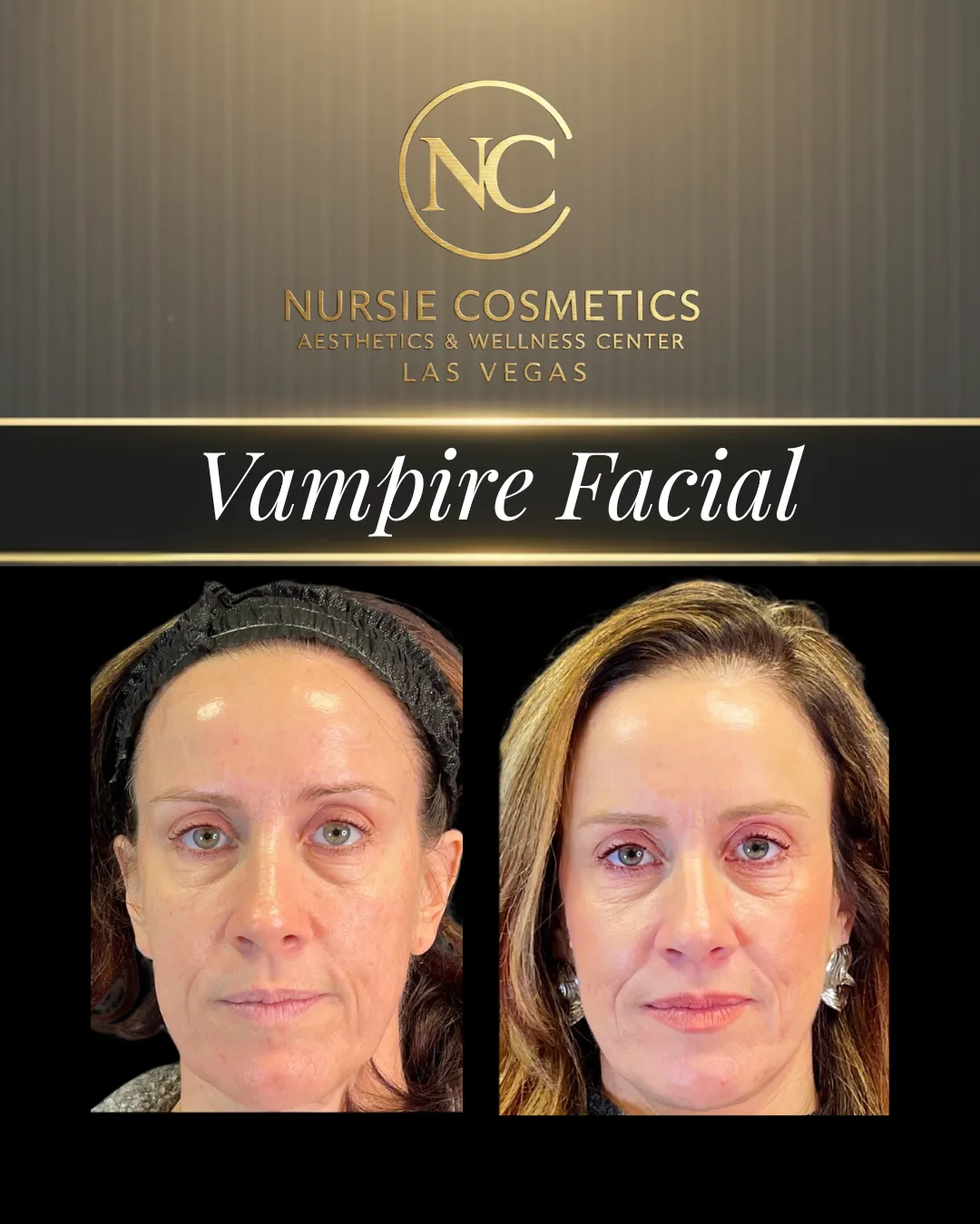 Before and after vampire facial with PRP