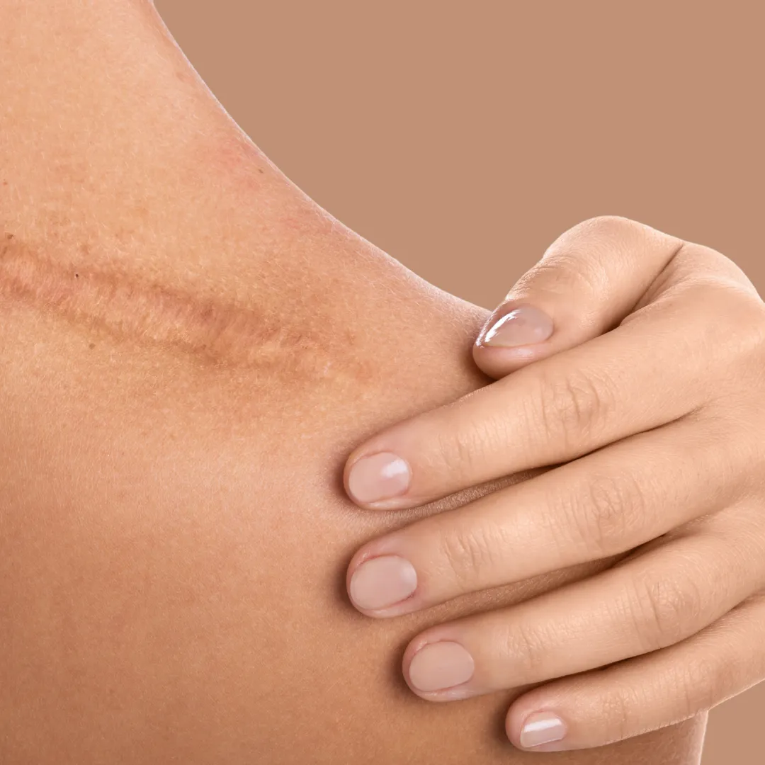 Scar therapy and skin texture treatment
